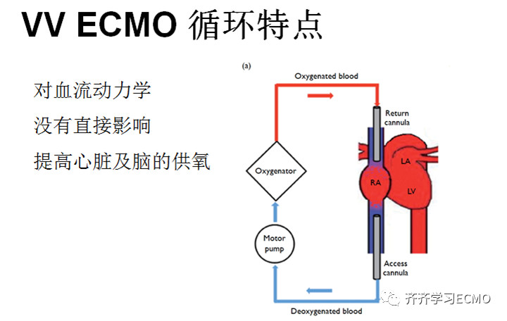ecmo基本结构图图片